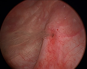 Confirm. vaginal hysterectomy resulted in hernia repair Pity, vaginal hysterectomy resulted in hernia repair