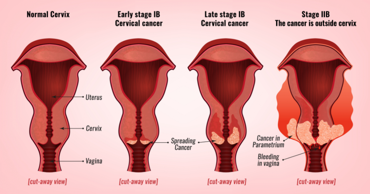 cervical cancer thesis pdf