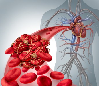 Blood clot risk