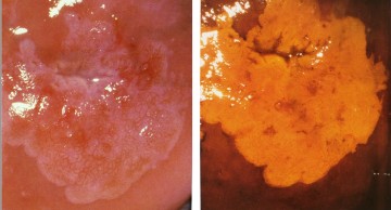 colposcopy