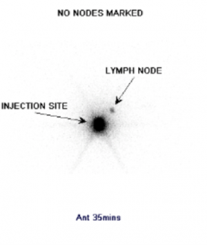sentinel node biopsy