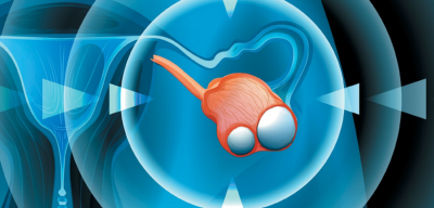 ovarian cancer tumour